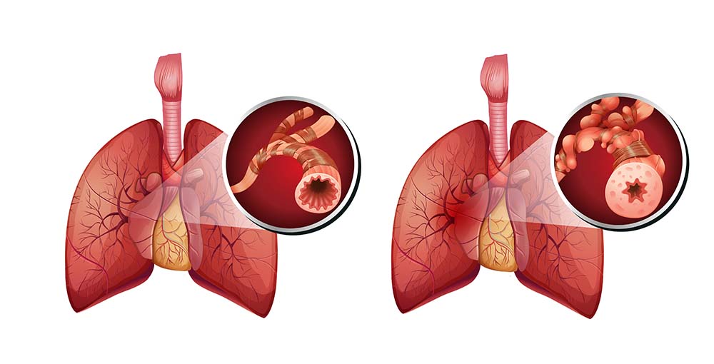 Fysiotherapie en COPD