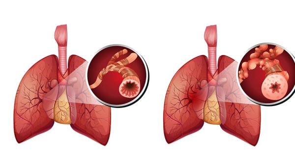 Fysiotherapie en COPD