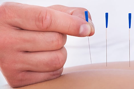 Dry Needling